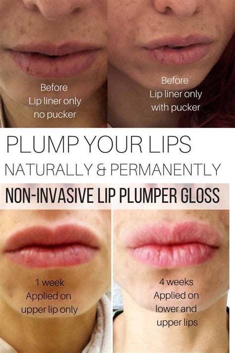 lip plumper permanent damage.